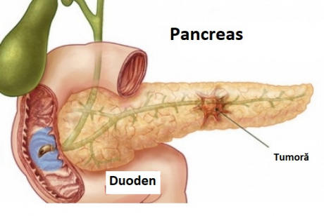 cancerul pancreatic se vindeca