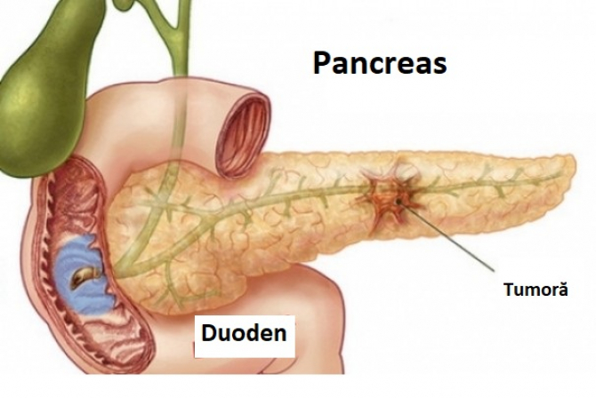 pancreas simptome pierdere în greutate