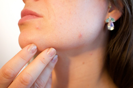 Un dermatolog poate elimina grăsimea. Punctele de grăsime (milia): cum se tratează corect