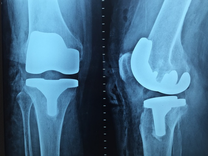 Instabilitatea genunchiului poate avea nevoie de intervenție chirurgicală