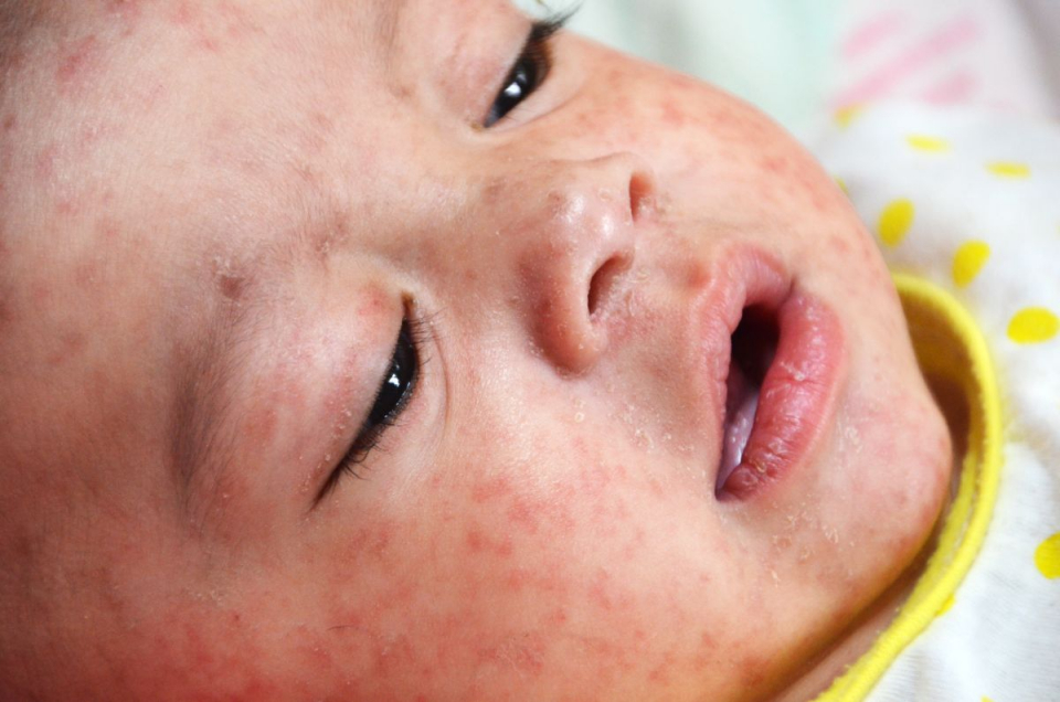 De la debutul epidemiei de rujeola, cele mai multe decese s-au inregistrat in randul copiilor. Foto: CDC/Jim Goodson, M.P.H