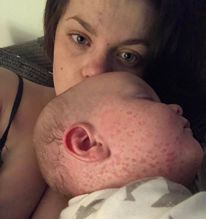 Bebelus cu rujeola. Foto: Emily Jane