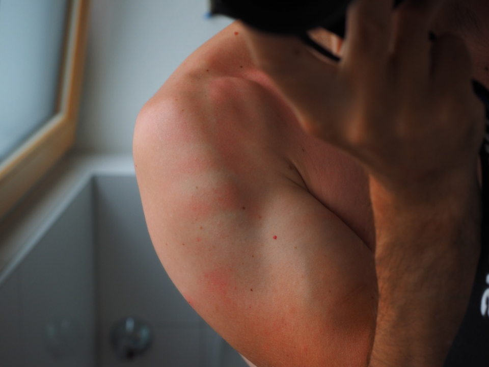 O iritatie de la transpiratie se poate transforma în eczema