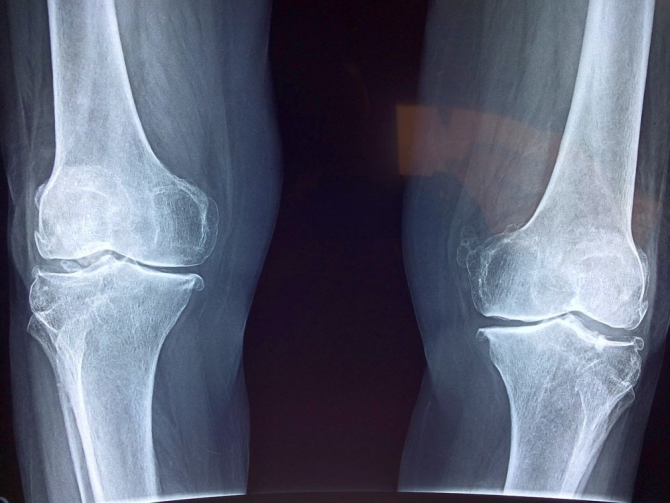 semne radiografice ale artrozei genunchiului