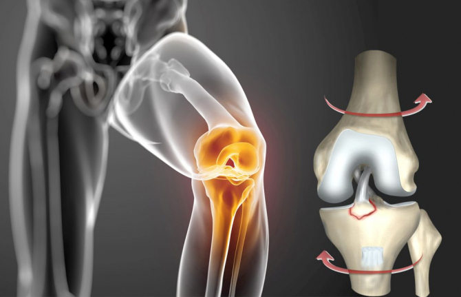 Sportiv sau nu, rupturi de ligamente putem face cu toții, mecanismul fiind același: de torsiune. Foto: Sanador