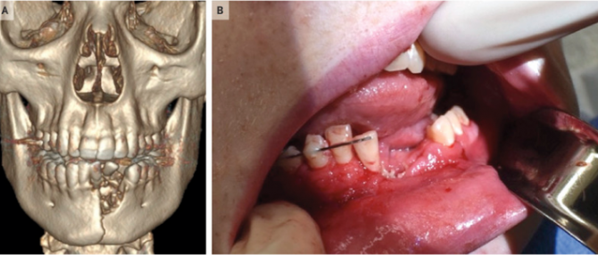 O țigaretă electronică i-a distrus unui adolescent mandibula  FOTO: The New England Journal of Medicine