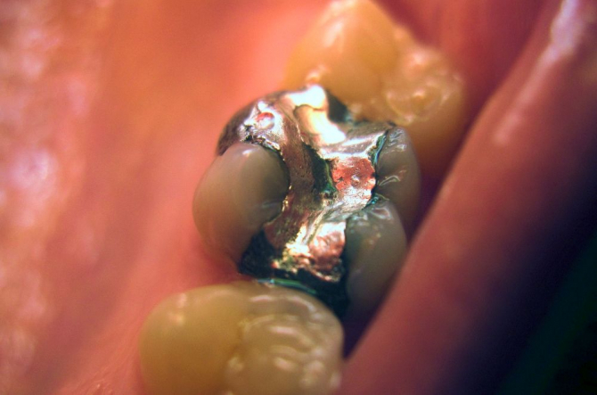 Amalgame dentare și metale grele - Naturopatie și hirudoterapie