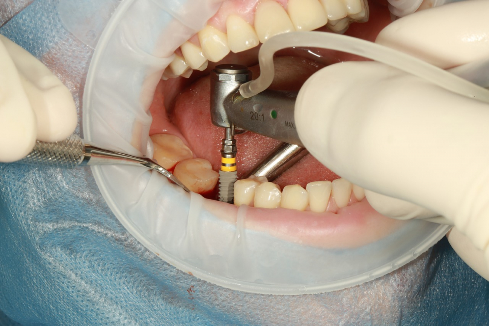 Implant dentar    Foto: pixabay.com
