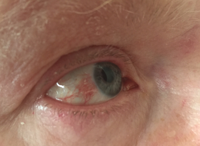 varicoza în interiorul ochiului operaiune varicoza video laser