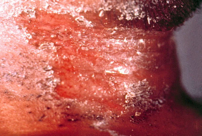 Leziuni provocate de difteria pe gâtul unui pacient adult. Foto: CDC