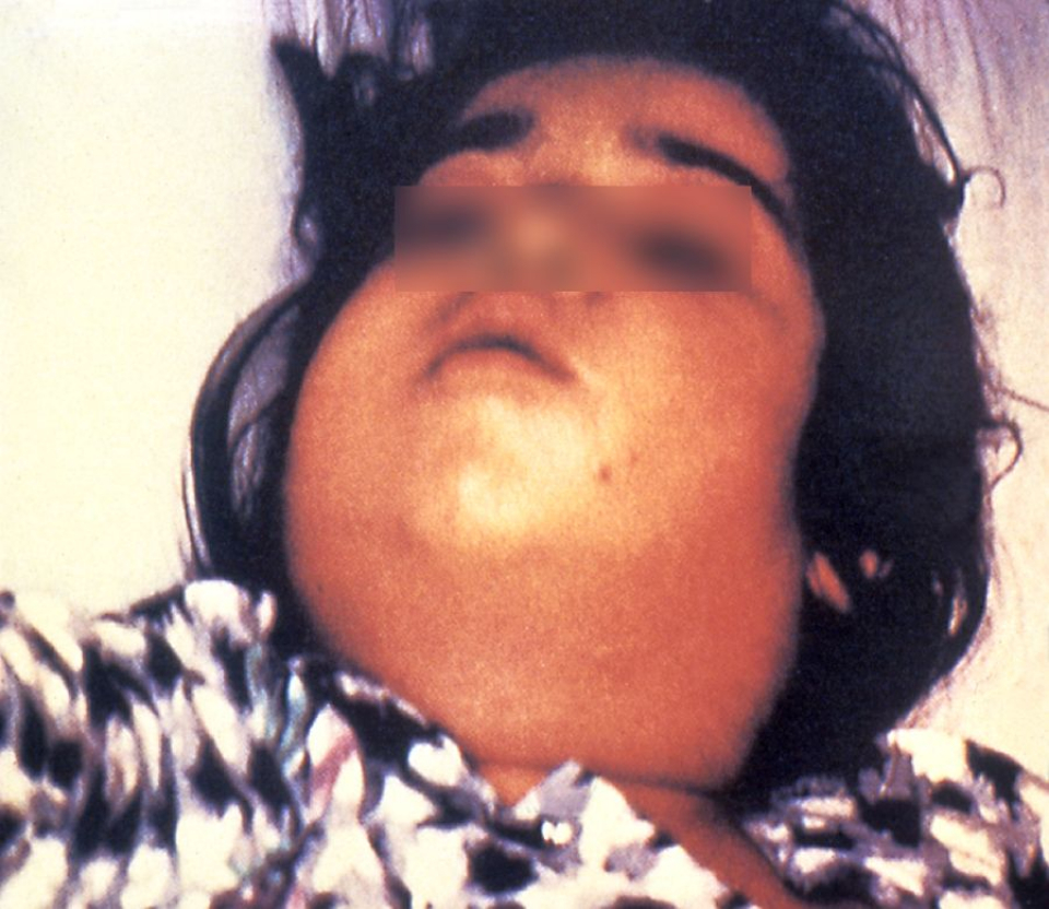 Copil cu gâtul afectat de difterie. Foto: CDC