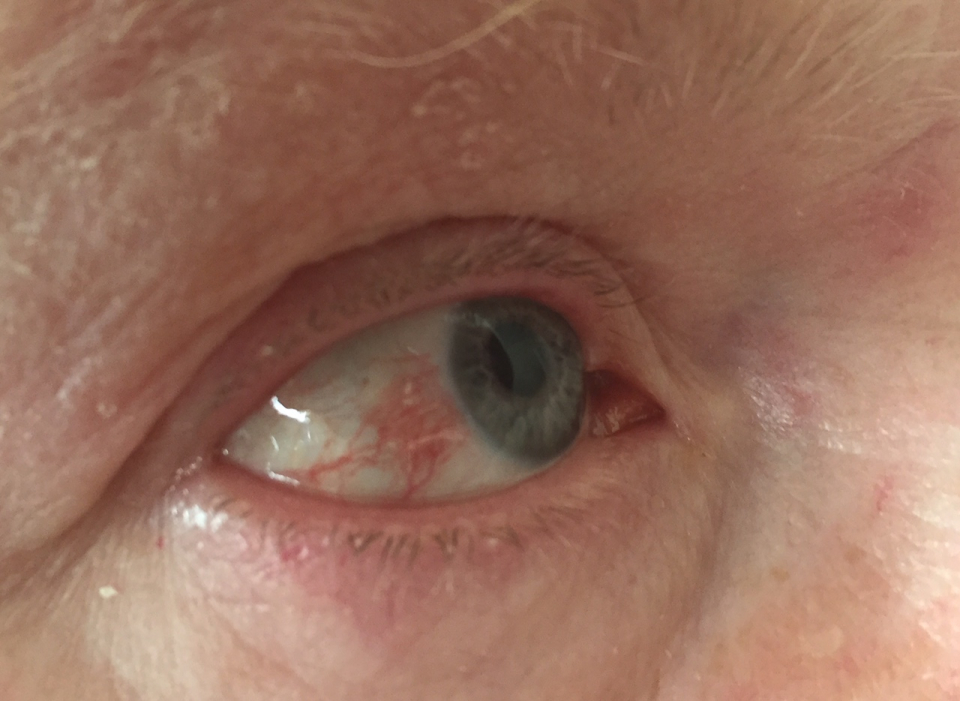  Fără tratament, zona zoster oculară poate duce la probleme grave, inclusiv pierderea vederii pe termen lung și cicatrizarea permanentă din cauza umflarii corneei.FOTO Wikipedia