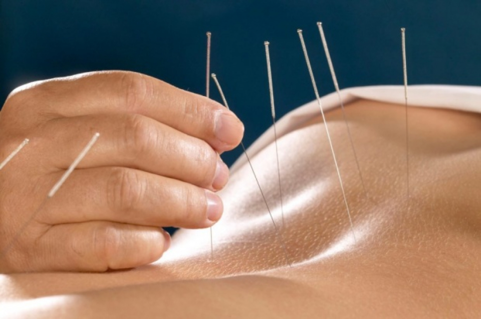 Acupunctura       Sursa foto: antena3.ro