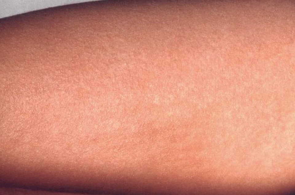 La persoanele cu scarlatina pe piele apare o eruptie. Foto: CDC