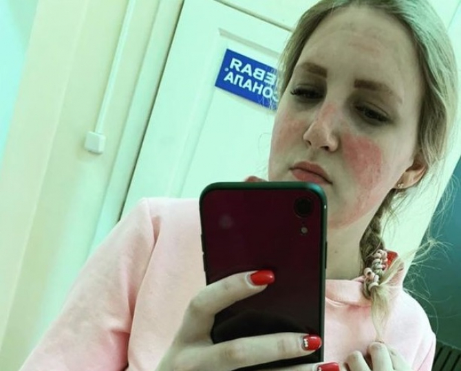 Tânăra a suferit arsuri pe față din cauza dezinfectantului utilizat    