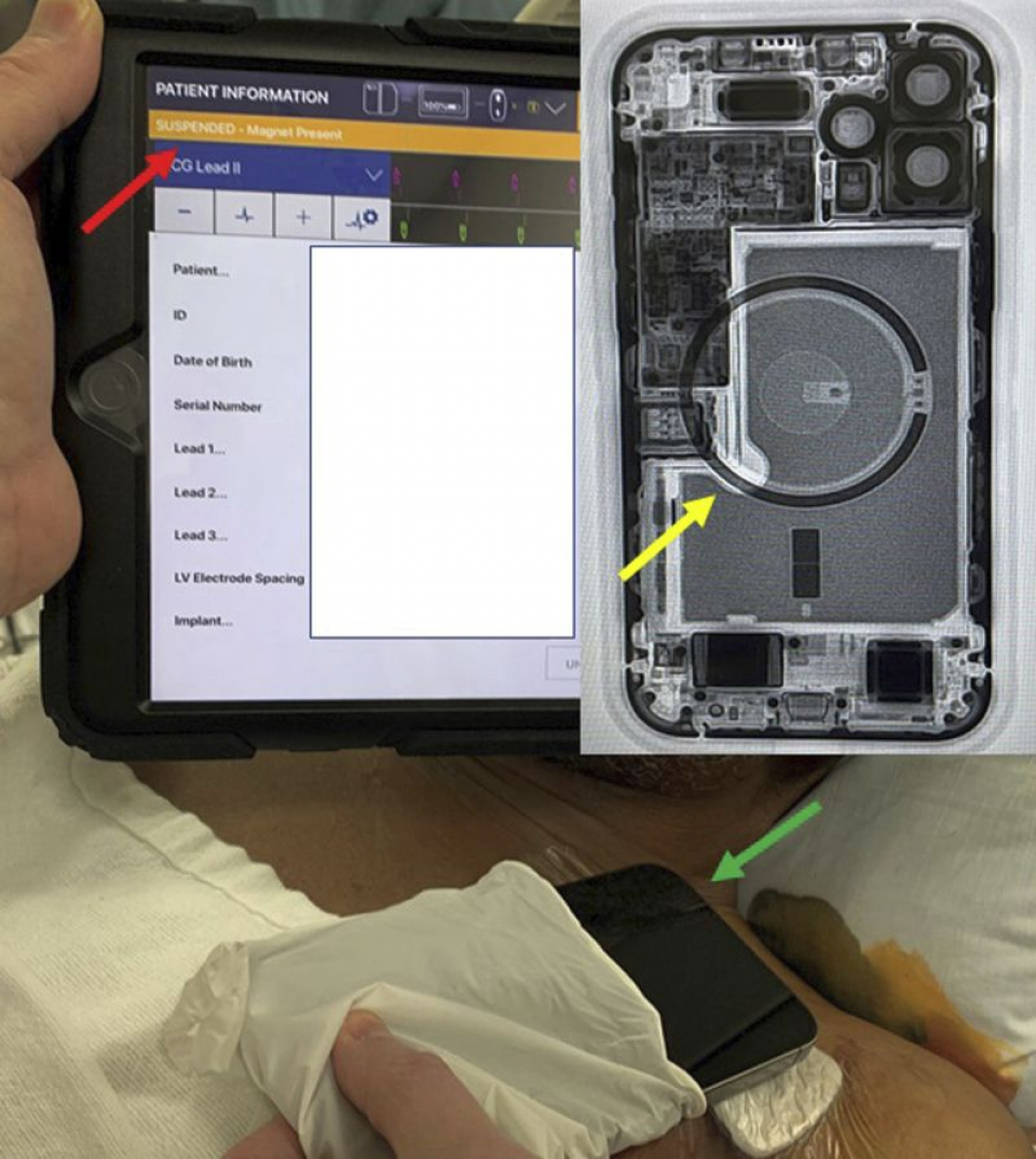 Programator de dispozitive care arată suspendarea terapiilor implantabile cu cardioverter-defibrilator (bara portocalie indicată cu săgeata roșie) cu iPhone 12 așezat pe pieptul pacientului (săgeata verde) și fluoroscopia iPhone 12 care prezintă matricea 