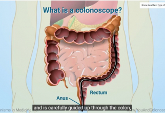 Colonoscopie. Foto: Print screen „You and Colonoscopy”/ Youtube