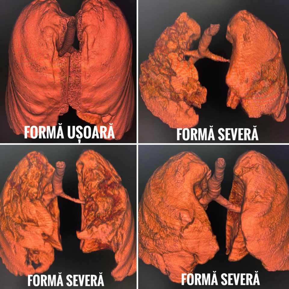 Tomografii a unor plămâni sănătăoși și a altora bolnavi de COVID  FOTO: Facebook RoVaccinare