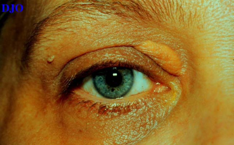 Colesterolul se poate depozita sub piele   Foto:  Digital Journal of Ophthalmology