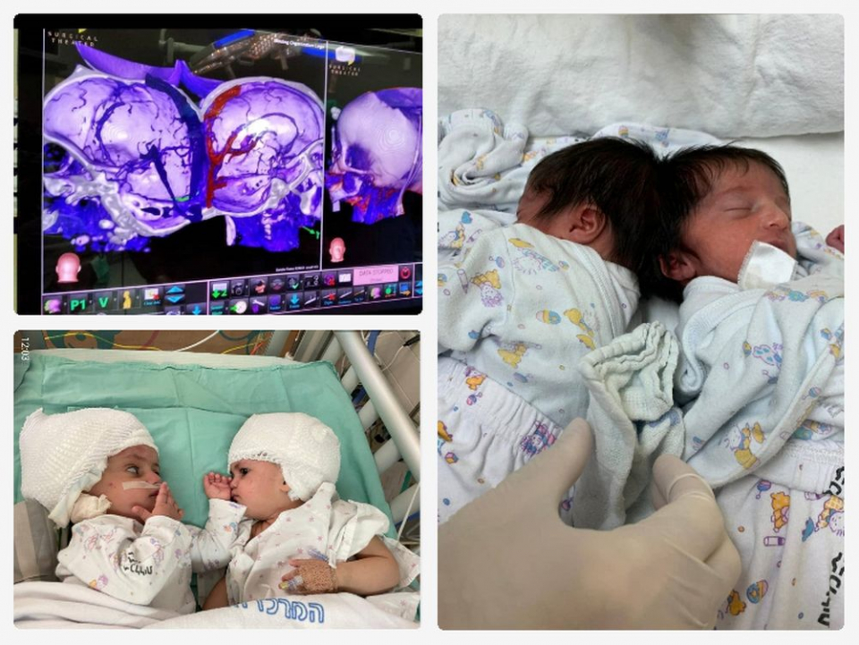 Gemenii s-au născut cu craniile unite la bază. Fotografii colaj:  Soroka Medical Center in Be’er Sheva 