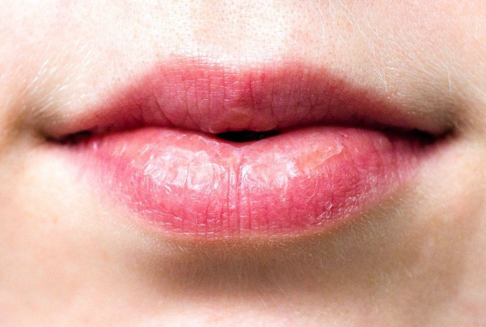 Cum scapi de buzele crăpate și uscate. Foto: Pixabay