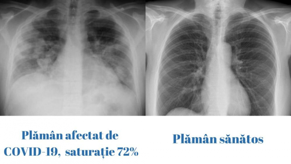 Plămân afectat de COVID-19 (stânga) și plămân normal (dreapta). Foto: #rovaccinare