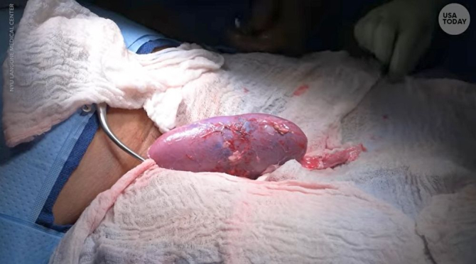 Un rinichi de la un porc, transplantat cu succes la un om. Foto: Video Transplant Institute at NYU Langone Health