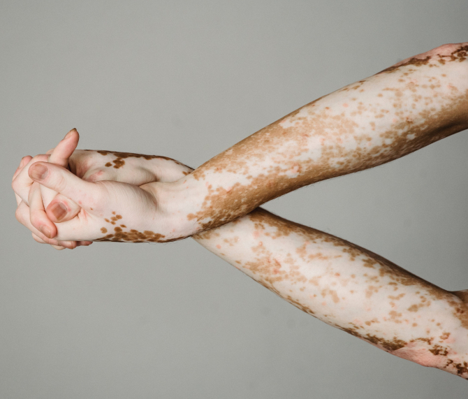Vitiligo – FOTO: Pexels@Armin_Rimoldi