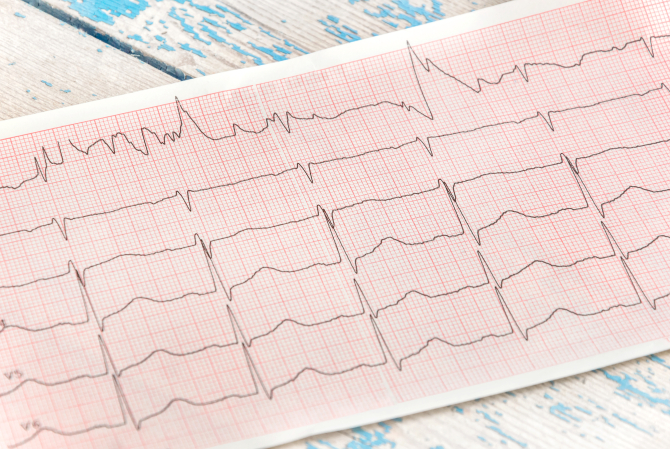 Cum recunoști un infarct pe EKG - Foto: Freepick @igorkoter