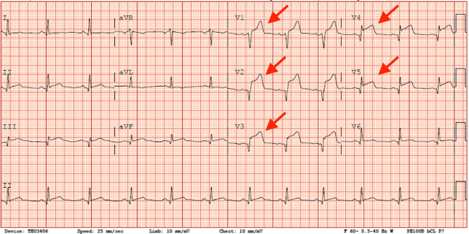 1. Foto: blog... (cum-sa-recunosti-un-infarct-miocardic-pe-electrocardiograma_76226600.jpg)