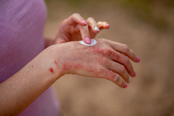 2. -imagine fara descriere- (eczema-hands-woman-applying-ointment-creams-treatment-eczema-psoriasis-other-skin-diseases-skin-problem-concept_90312400.jpg)