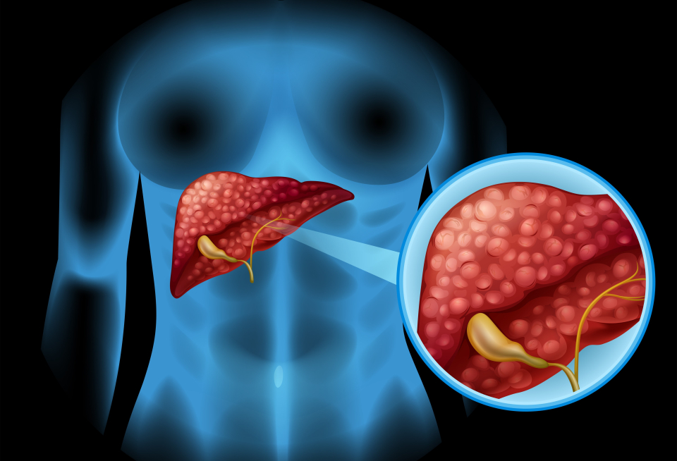 Cum știi dacă ai o tumoare hepatică - Foto: Freepick