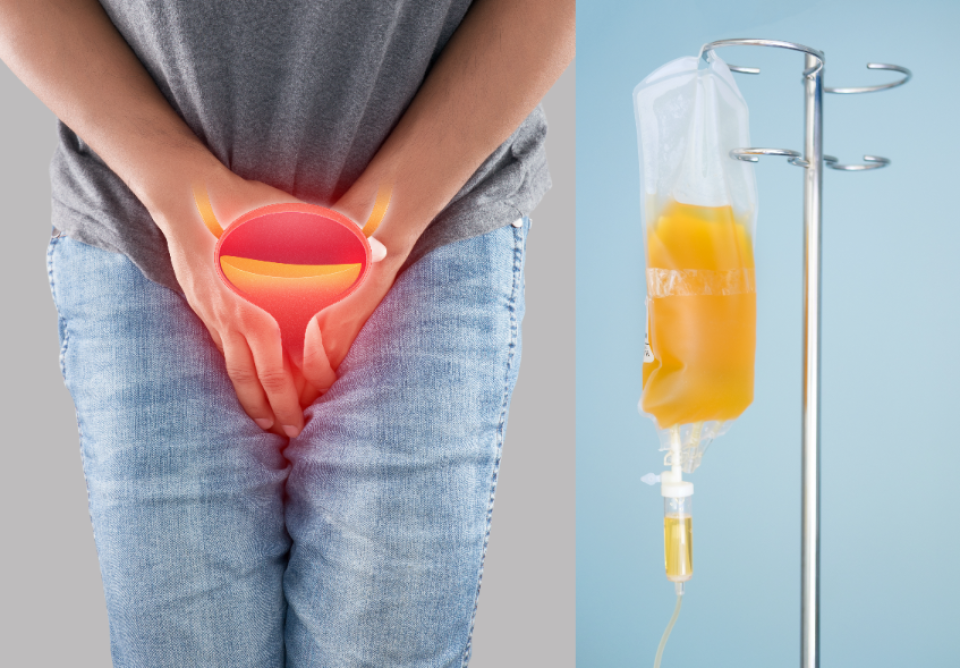 Sonda urinara - Foto: Freepick