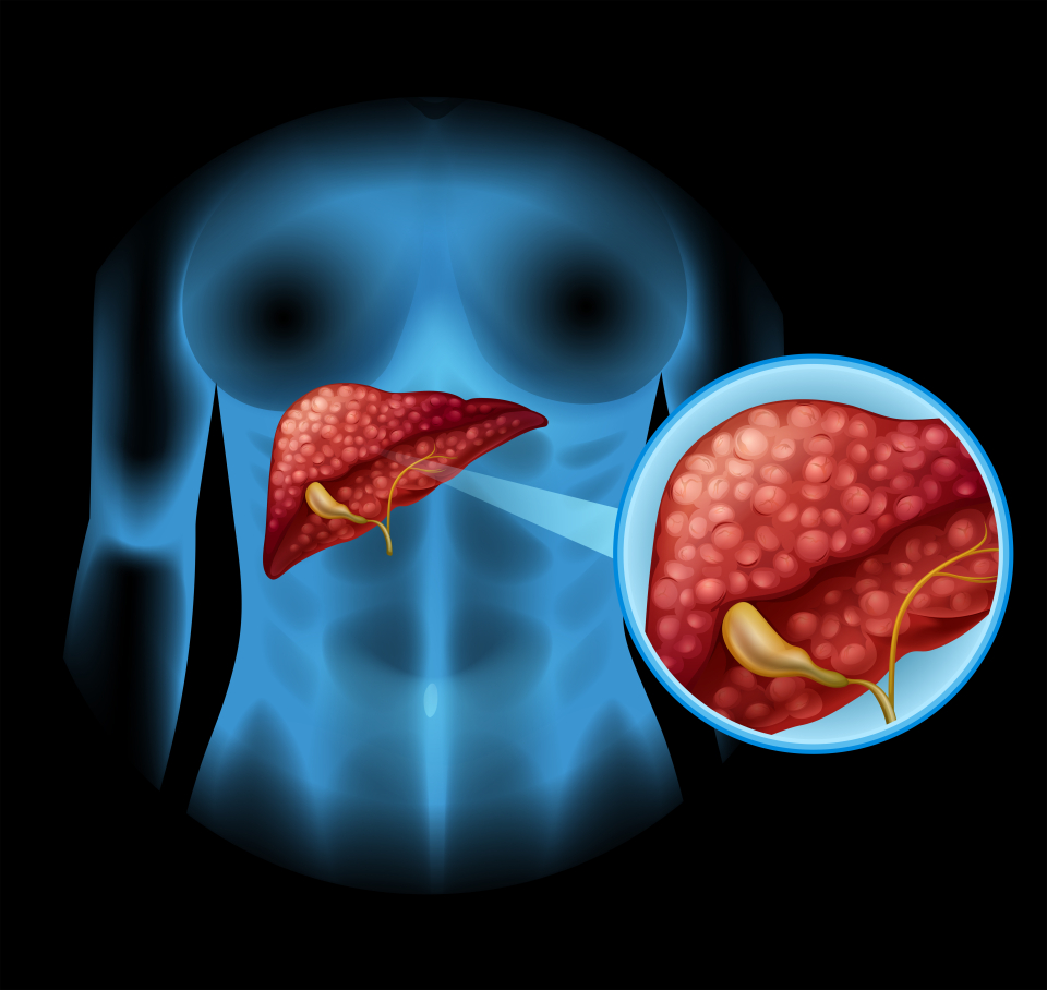 cancerul pancreatic - FOTO: Freepik@brgfx